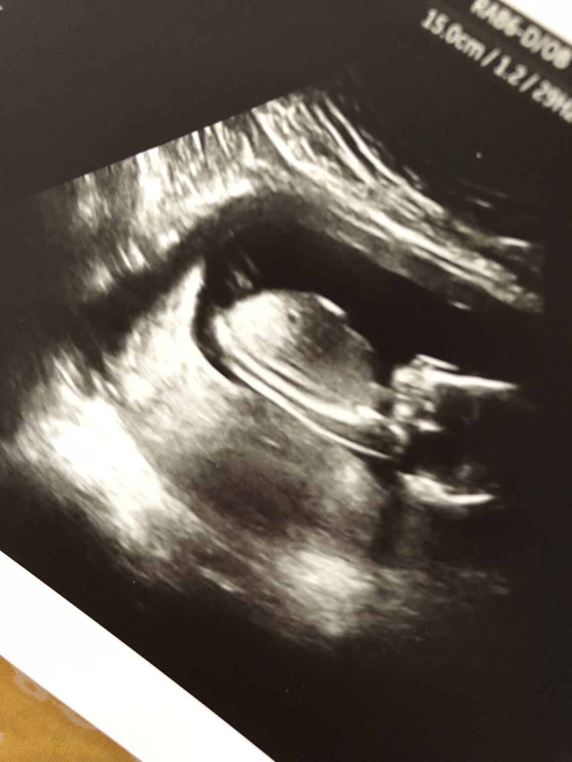 15 Week Ultrasound Baby 5 - Budget Savvy Diva